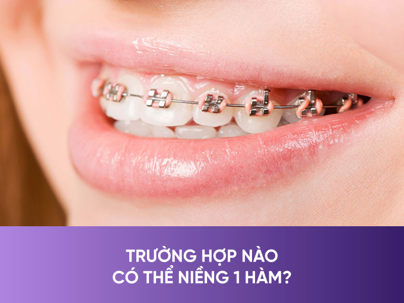 Có Nên Niềng Răng Kim Loại 1 Hàm Không? Giá Bao Nhiêu?