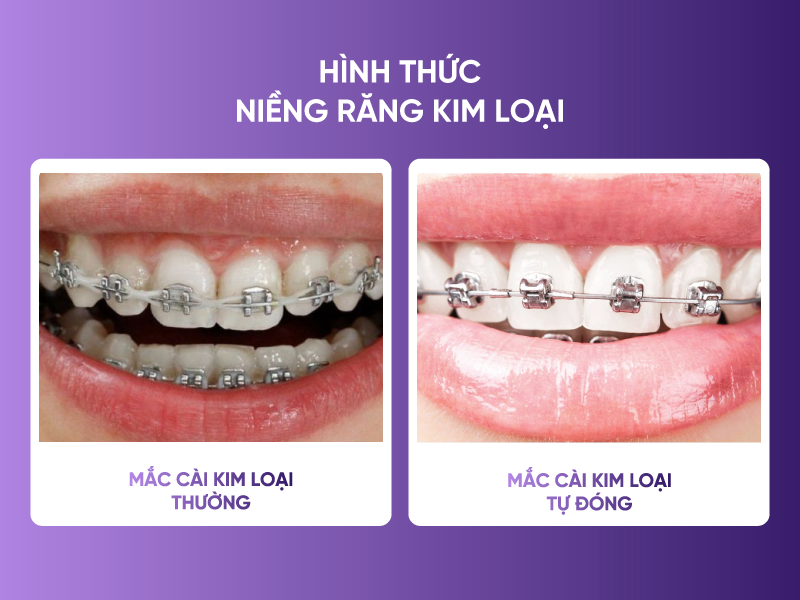 Niềng Răng Mắc Cài Sứ Hay Kim Loại - Giải Đáp Từ Chuyên Gia