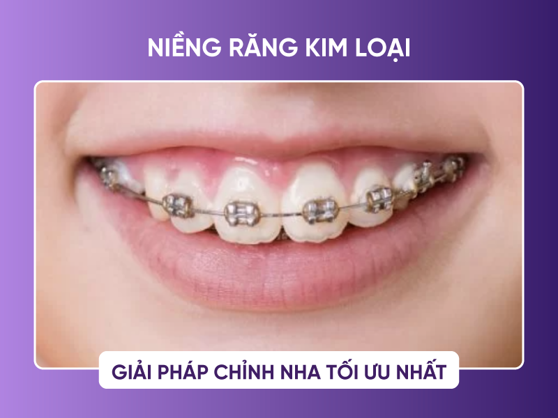 Niềng Răng Kim Loại An Toàn, Hiệu Quả Và Tiết Kiệm Chi Phí
