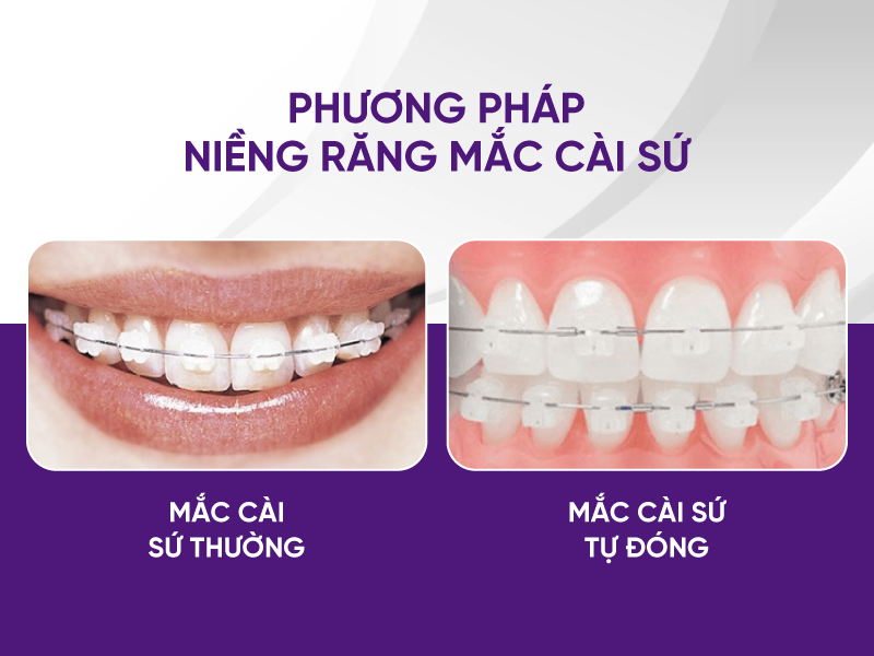 Niềng Răng Mắc Cài Sứ Hay Kim Loại - Giải Đáp Từ Chuyên Gia
