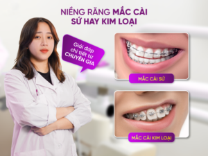 Niềng Răng Mắc Cài Sứ Hay Kim Loại - Giải Đáp Từ Chuyên Gia