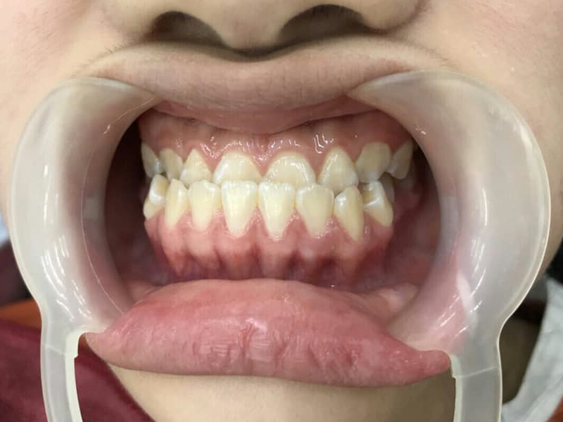 Niềng Răng Móm Hàm Trên Và Những Điều Bạn Cần Biết