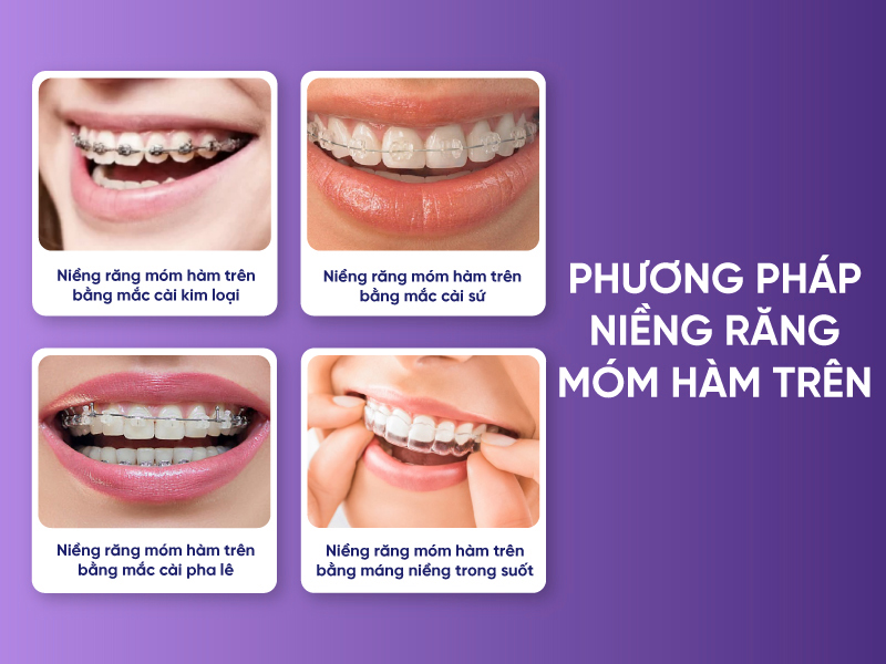 Niềng Răng Móm Hàm Trên Và Những Điều Bạn Cần Biết