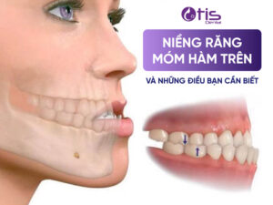 Niềng Răng Móm Hàm Trên Và Những Điều Bạn Cần Biết