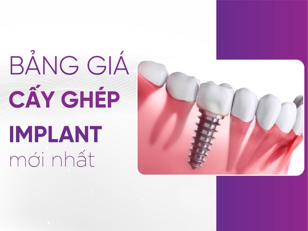 Bảng Giá Cấy Ghép Implant Mới Nhất 2025