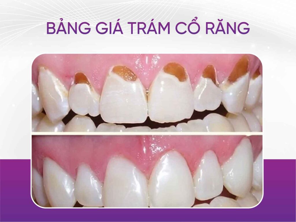 Bảng giá trám răng mới nhất 2025 Bảng Giá Trám Cổ Răng