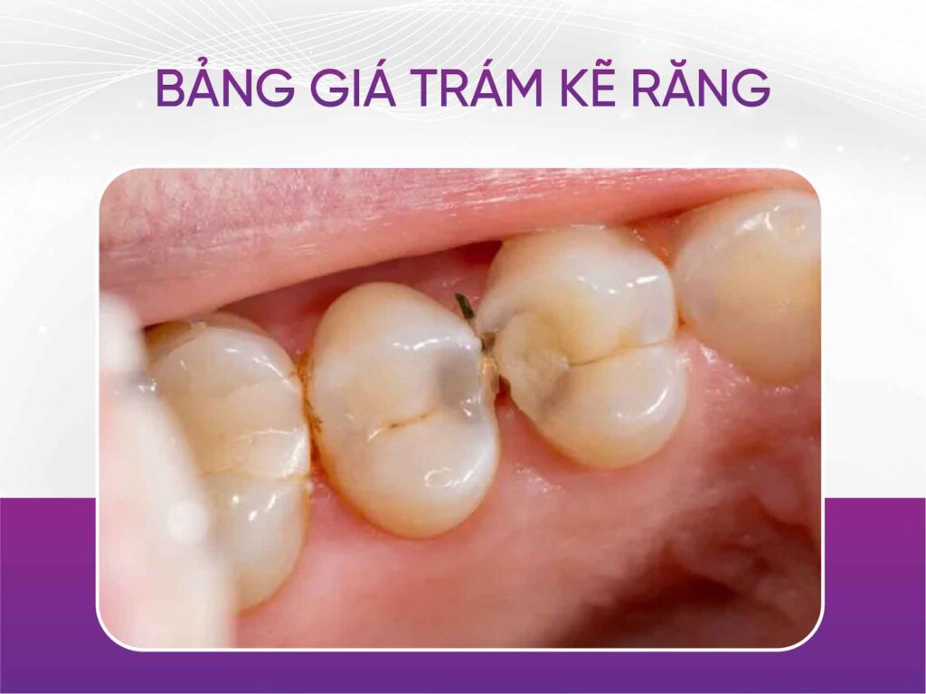 Bảng giá trám răng mới nhất 2025 Bảng Giá Trám Kẽ Răng