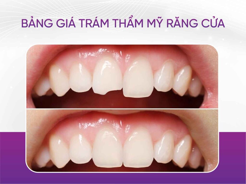 Bảng giá trám răng mới nhất 2025 Bảng Giá Trám Thẩm Mỹ Răng Cửa