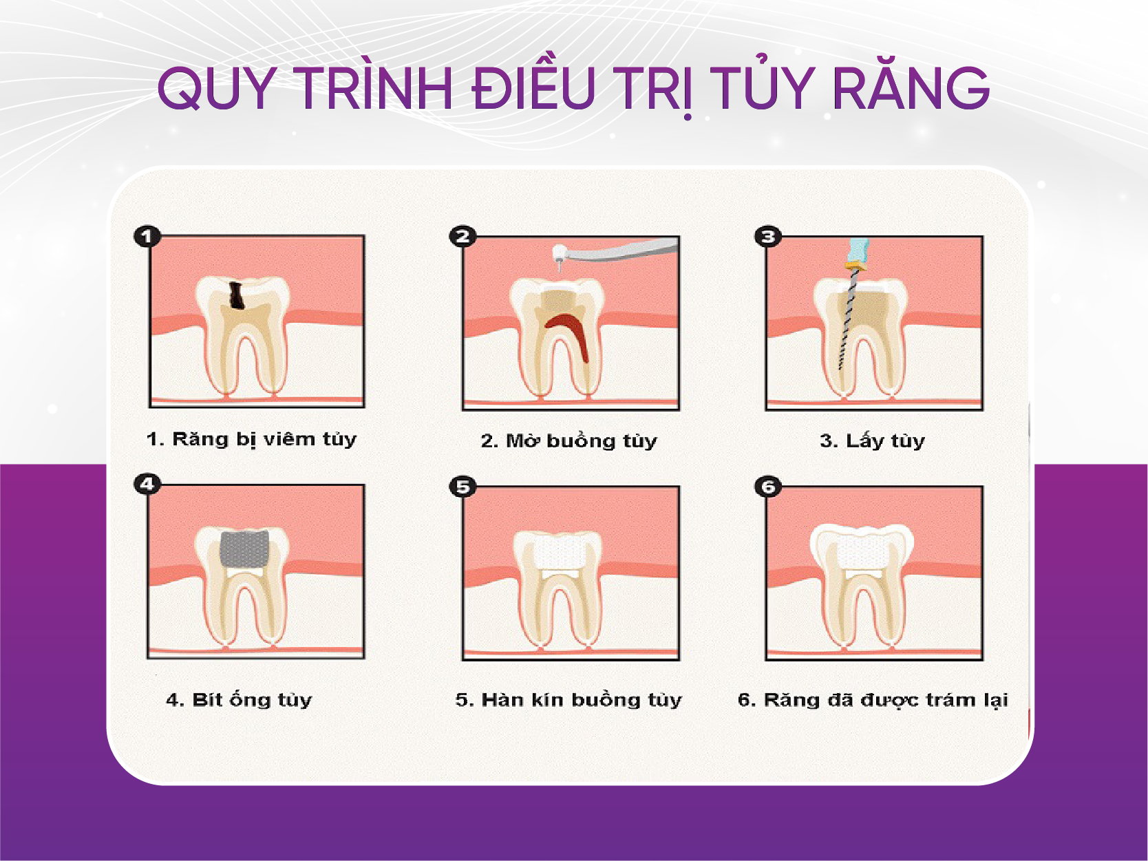 Bảng giá điều trị tủy răng mới nhất 2025