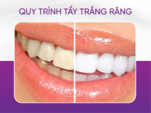 Quy Trình 6 Bước Tẩy Trắng Răng Chuẩn Y Tế