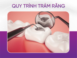 Quy Trình Trám Răng 6 Bước Theo Chuẩn Bộ Y Tế