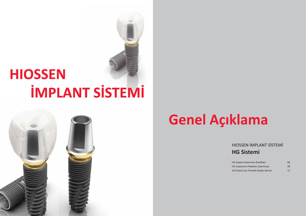 Trụ Implant Hiossen và 4 đặc điểm nổi bật Trụ Implant Hiosen