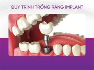 Quy Trình Trồng Răng Implant