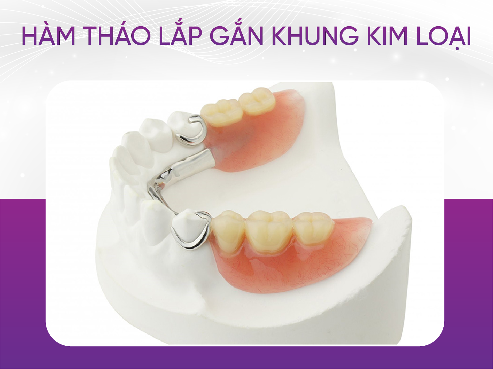 3 loại răng giả hàm tháo lắp phổ biến nhất hiện nay Hàm Tháo Lắp Gắn Khung Kim Loại