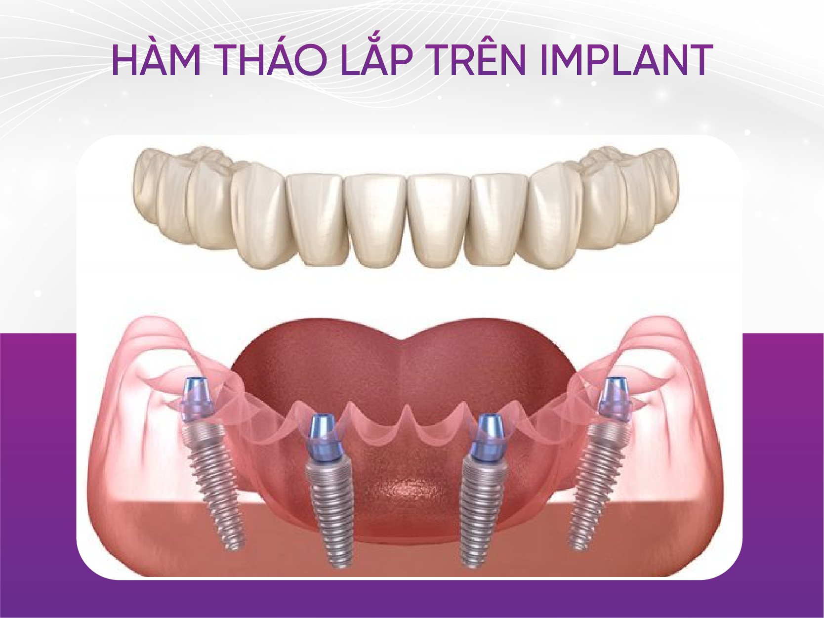 3 loại răng giả hàm tháo lắp phổ biến nhất hiện nay Hàm Tháo Lắp Trên Implant