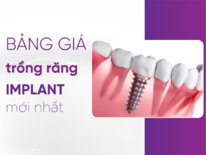 Bảng giá trồng răng Implant mới nhất