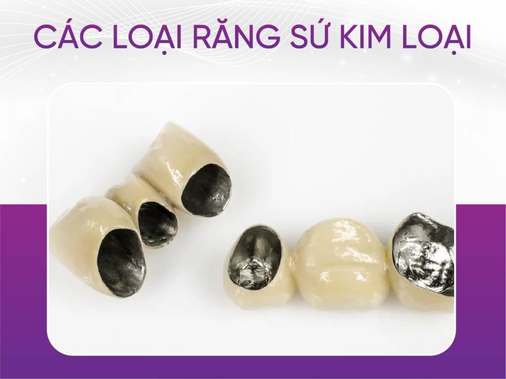 3 loại răng sứ kim loại mà khách hàng ưa chuộng nhất Các Loại Răng Sứ Kim Loại