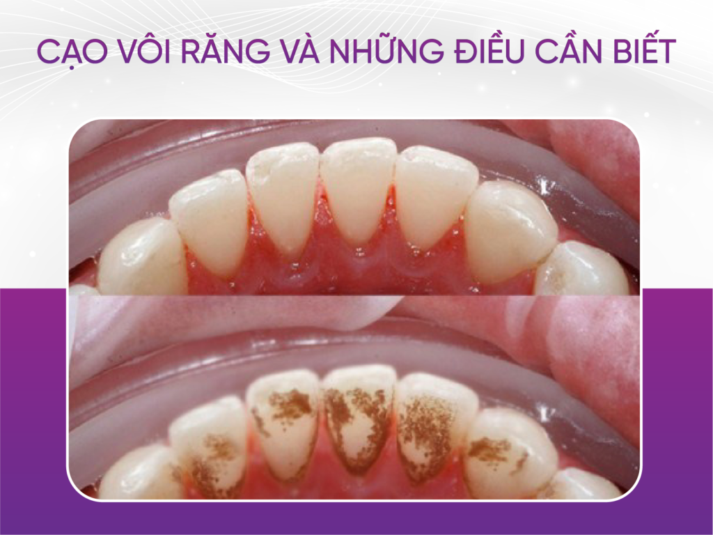 Cạo Vôi Răng
