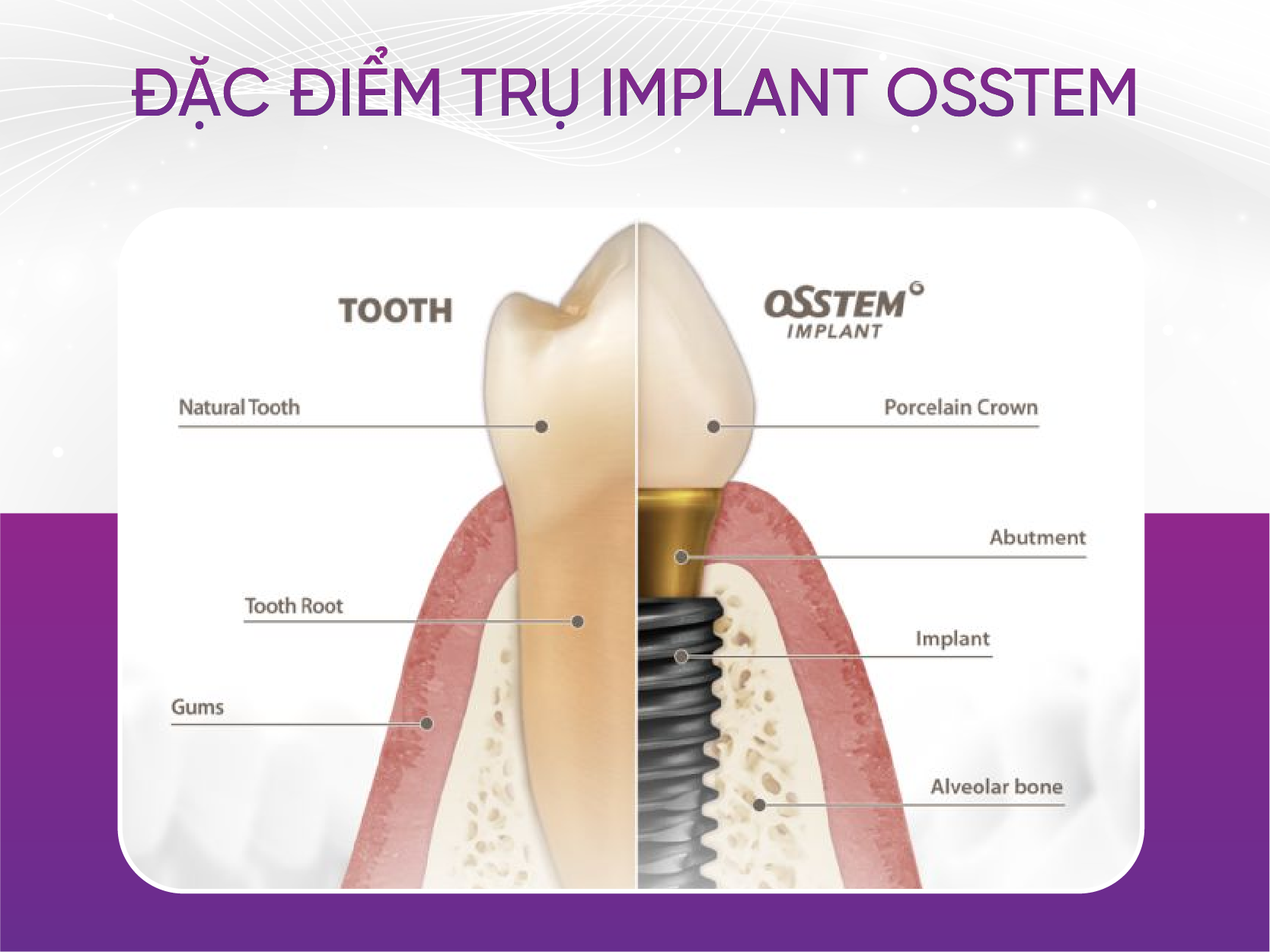 Trụ Implant Osstem tuổi thọ trên 20 năm Đặc Điểm Trụ Implant Osstem