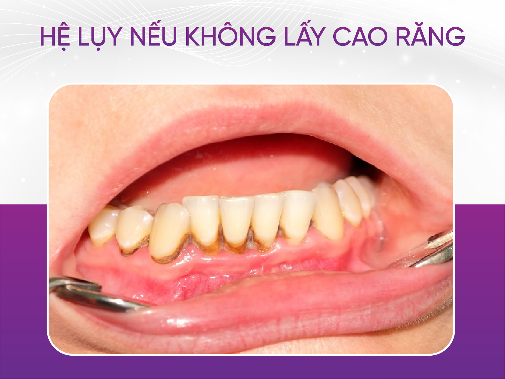 Cạo vôi răng và 7 lưu ý bạn nhất định phải biết Hệ Lụy Nếu Không Lấy Cao Răng