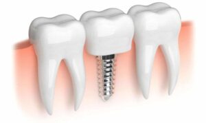 Chọn những dòng Implant chất lượng