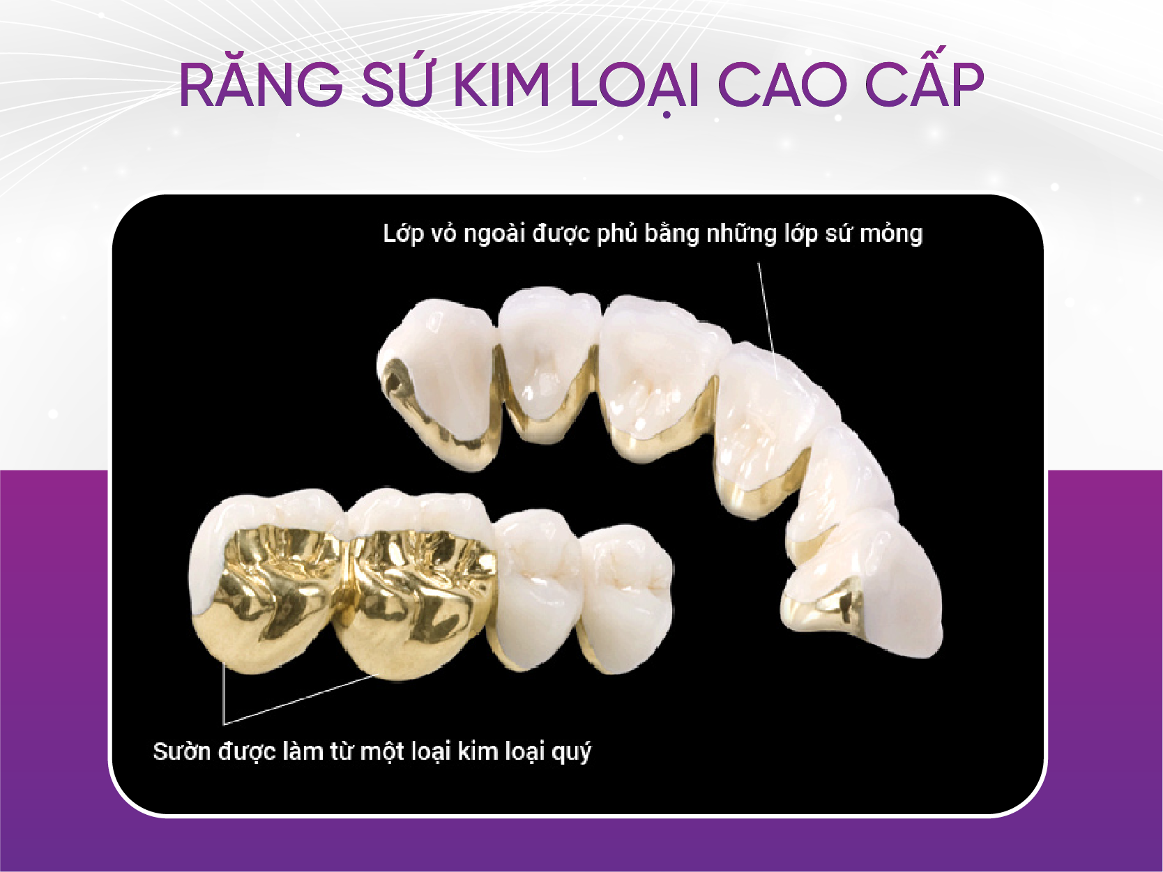 3 loại răng sứ kim loại mà khách hàng ưa chuộng nhất Răng Sứ Kim Loại Cao Cấp