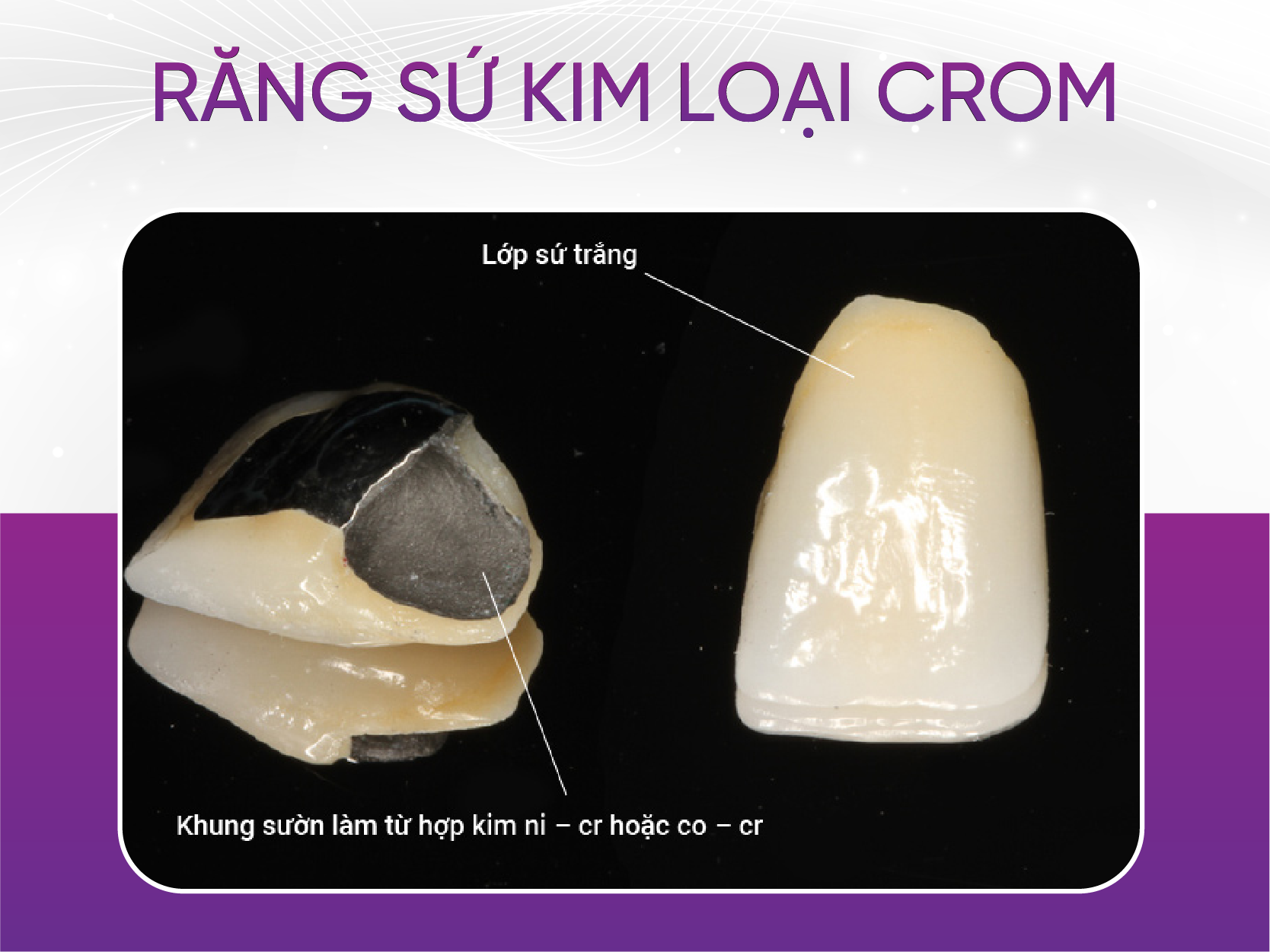 3 loại răng sứ kim loại mà khách hàng ưa chuộng nhất Răng Sứ Kim Loại Crom