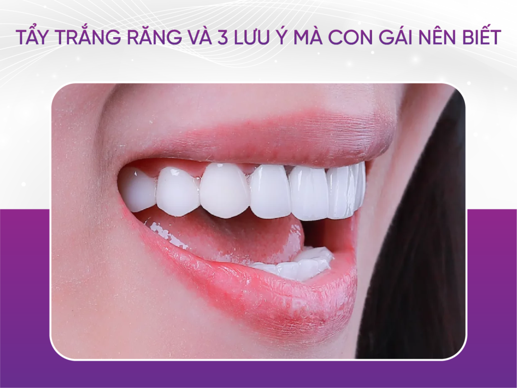 3 lưu ý về tẩy trắng răng mà con gái nên biết Tẩy Trắng Răng Và 3 Lưu Ý Về Tẩy Trắng Răng Con Gái Nên Biết