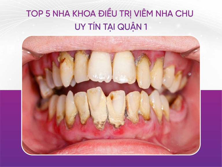 Viêm Nha Chu Là Gì? Top 5 Nha Khoa Điều Trị Viêm Nha Chu Uy Tín Tại Quận 1