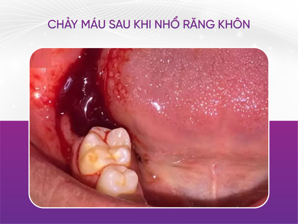 3 dấu hiệu nhiễm trùng sau khi nhổ răng khôn Dấu Hiệu Nhiễm Trùng Sau Khi Nhổ Răng Khôn