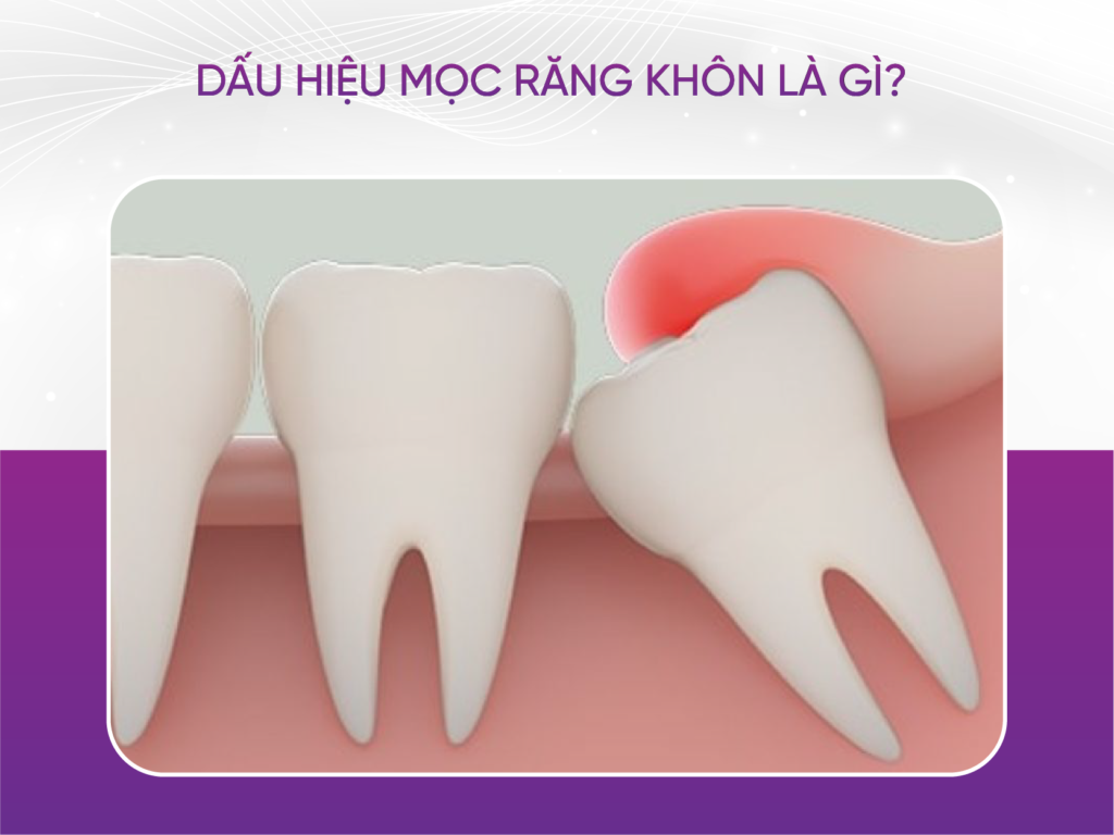 5 dấu hiệu mọc răng khôn bạn cần biết Dấu Hiệu Mọc Răng Khôn Là Gì?