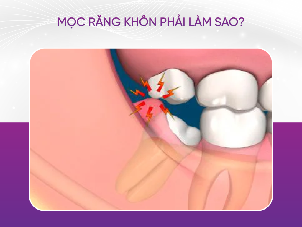 5 dấu hiệu mọc răng khôn bạn cần biết Mọc Răng Khôn Phải Làm Sao?
