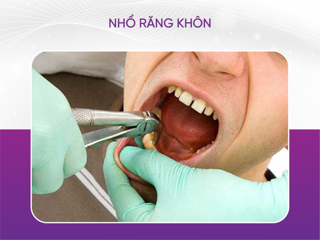 5 dấu hiệu mọc răng khôn bạn cần biết Có Nên Nhổ 2 Răng Khôn Hàm Dưới 1 Lúc Không?