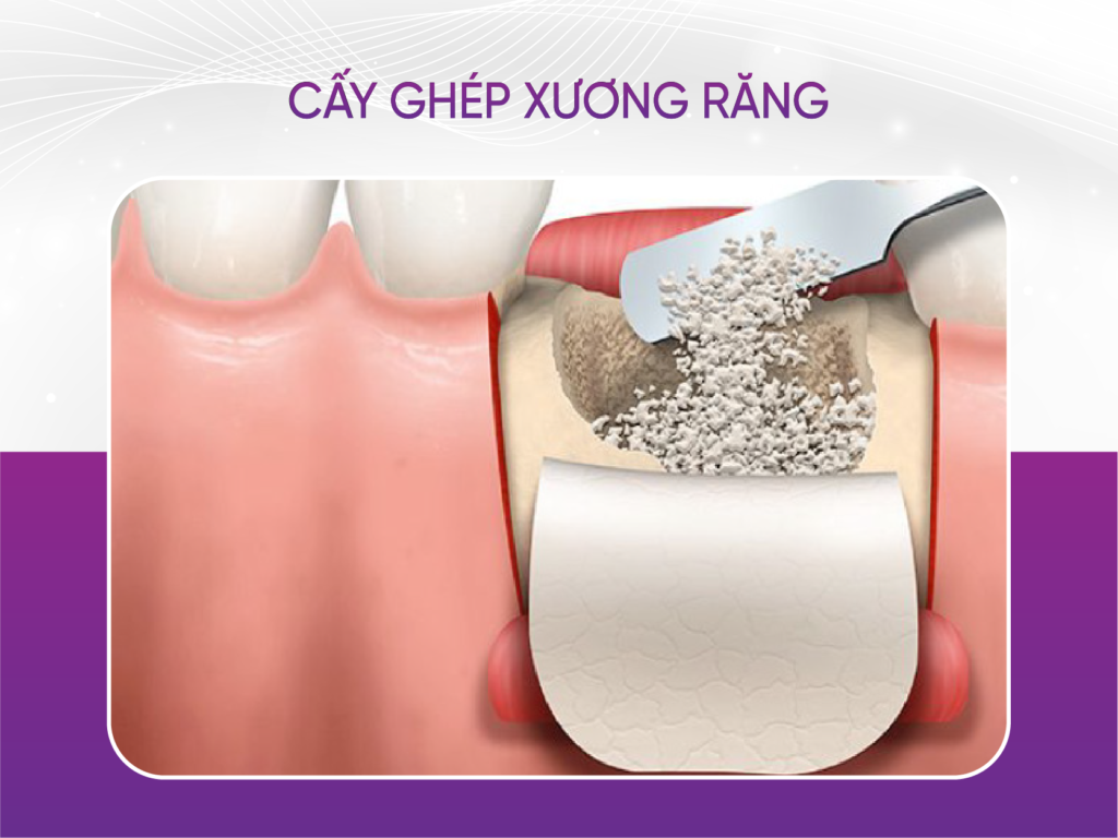 Top Những Nha Khoa Ghép Xương Răng Uy Tín Tại Quận 1