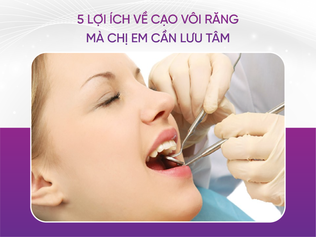 5 Lợi Ích Về Cạo Vôi Răng Mà Chị Em Cần Lưu Tâm