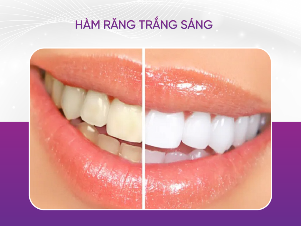 3 bí quyết để duy trì hàm răng trắng sáng cho phái đẹp Hàm Răng Trắng Sáng Khi So Với Răng Bình Thường