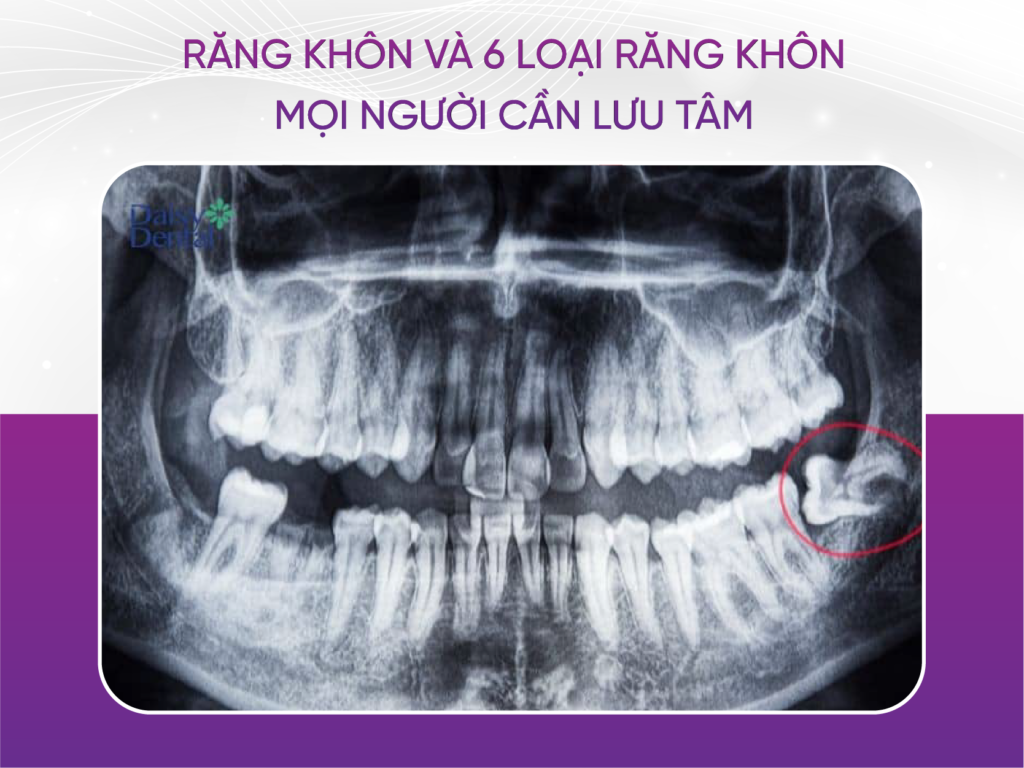 Răng Khôn Và 6 Loại Răng Khôn Mọi Người Cần Lưu Tâm