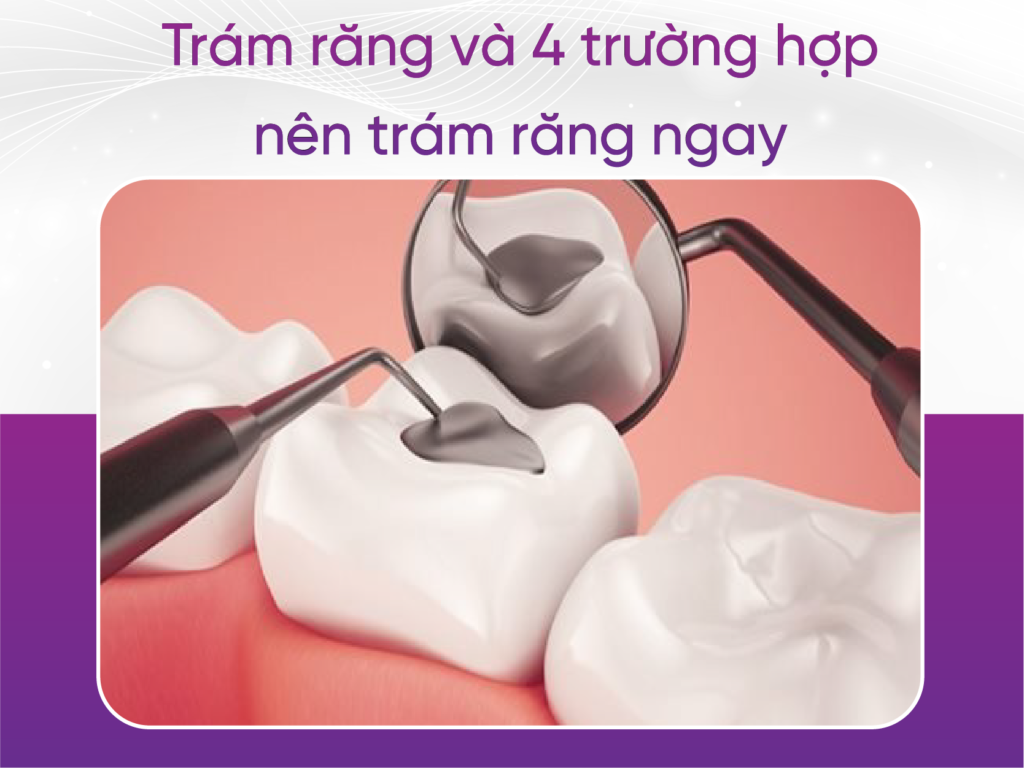 Trám Răng Và 4 Trường Hợp Nên Đi Trám Răng Ngay
