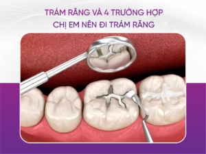 Trám Răng Và 4 Trường Hợp Chị Em Nên Đi Trám Răng