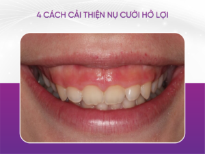 4 Cách Cải Thiện Nụ Cười Hở Lợi Cho Chị Em Phụ Nữ