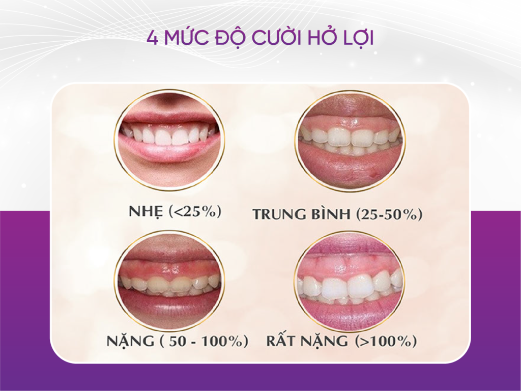4 cách cải thiện nụ cười hở lợi cho chị em phụ nữ 4 Mức Độ Cười Hở Lợi