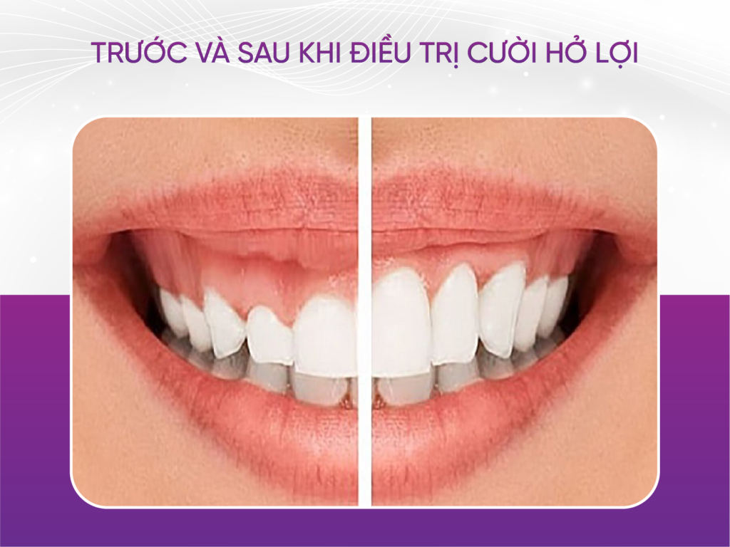 4 cách cải thiện nụ cười hở lợi cho chị em phụ nữ Trước Và Sau Khi Điều Trị Cười Hở Lợi
