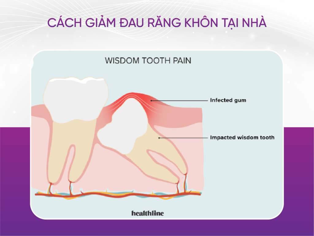 4 cách giảm đau răng khôn tại nhà Cách Giảm Đau Răng Khôn Tại Nhà