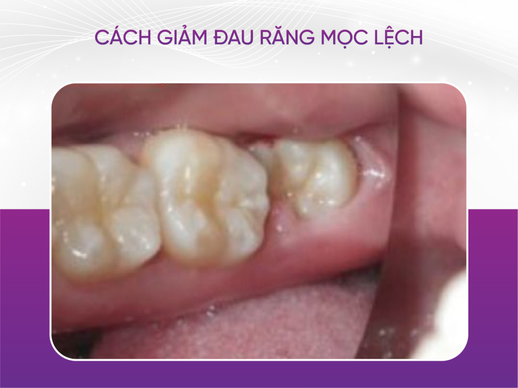 4 cách giảm đau răng khôn tại nhà Cách Giảm Đau Răng Khôn Mọc Lệch