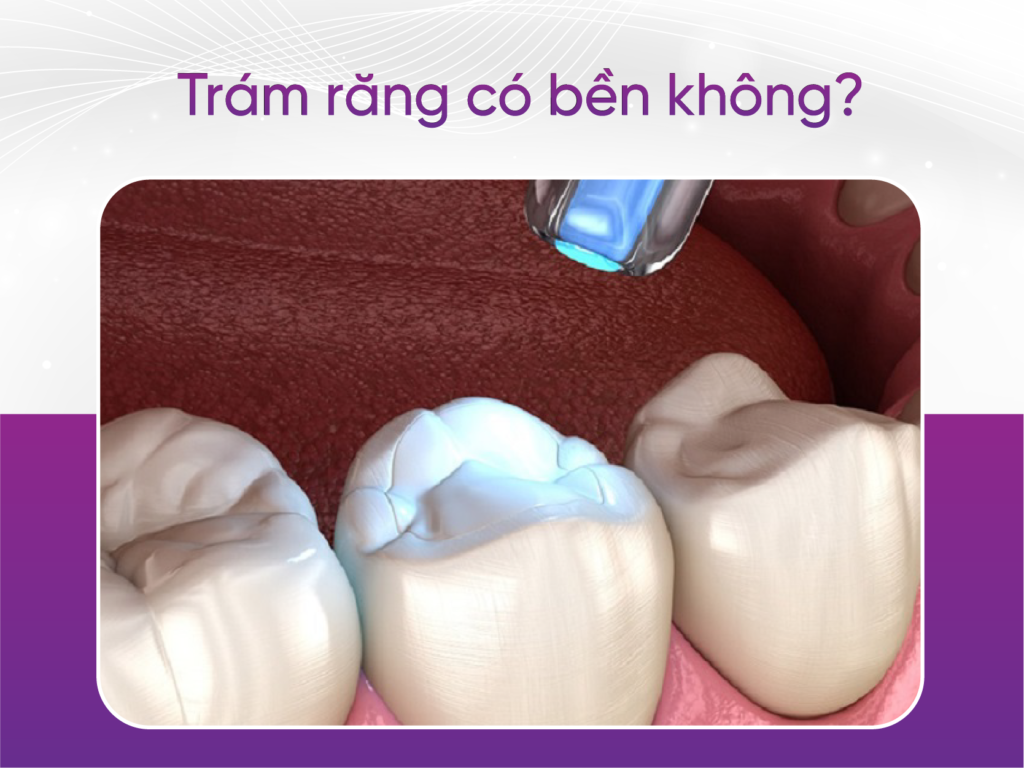 Trám răng và 4 trường hợp nên đi trám răng càng sớm càng tốt Trám Răng Có Bền Không?