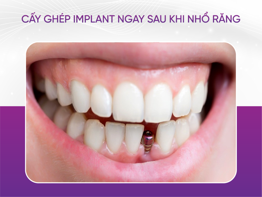 Thời điểm cấy ghép Implant tốt nhất là ngay sau khi nhổ răng