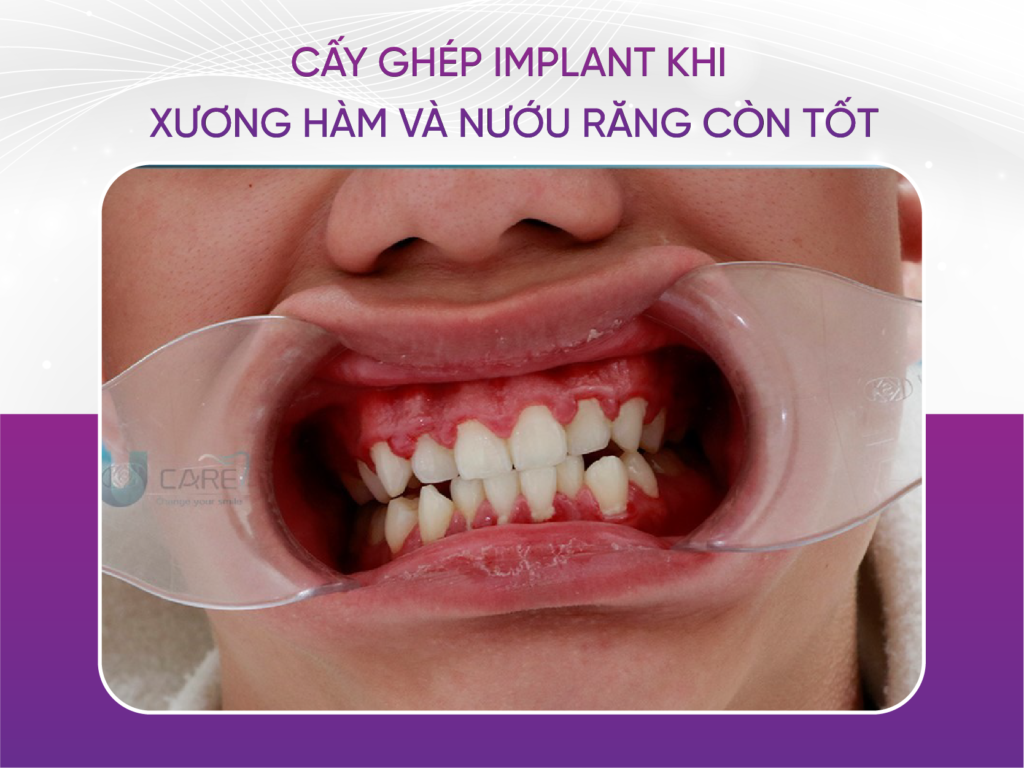 Thời điểm cấy ghép Implant tốt thứ ba là khi xương hàm và nướu vẫn còn tốt