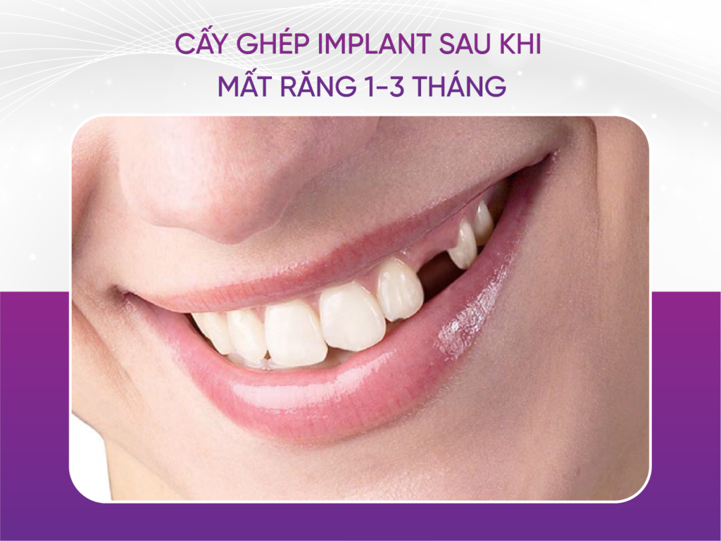 Thời điểm cấy Implant tốt thứ hai là sau khi mất răng 1-3 tháng