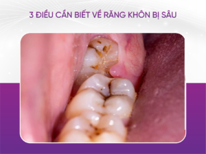 3 Điều Cần Biết Về Răng Khôn Bị Sâu