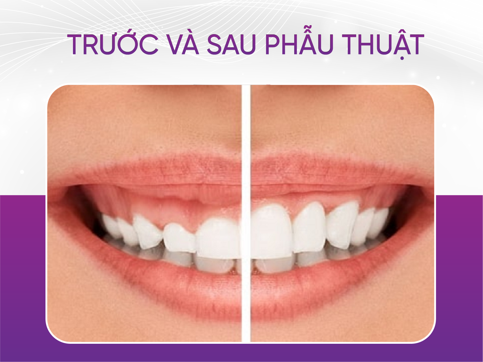 Cười hở lợi và 4 mức độ cười hở lợi mà khách hàng cần biết Trước Và Sau Khi Phẫu Thuật Chỉnh Cười Hở Lợi